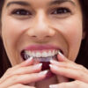 Bite dentale: cos’è modalità d’uso
