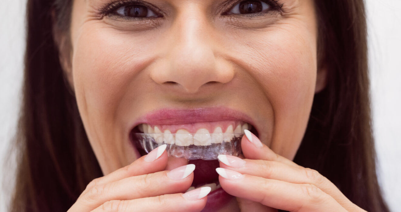 Bite dentale: cos’è modalità d’uso