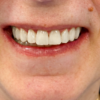 Rivoluziona il Tuo Sorriso con l'Injection Technique: Innovazione in Odontoiatria Estetica